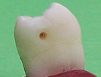 Zahn mit Präparation