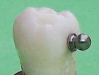 Zahn mit Kugelanker